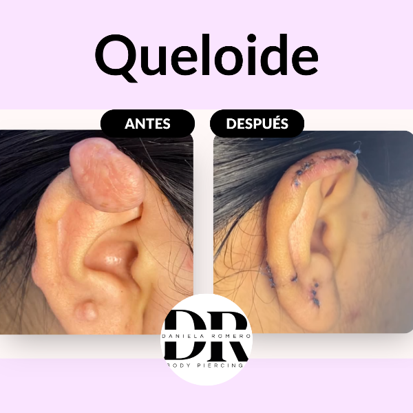 &iquest;Tienes un queloide luego de tu perforaci&oacute;n?