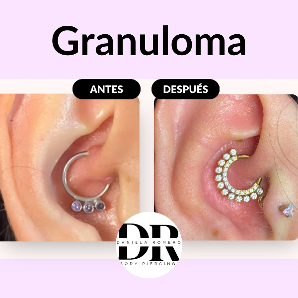 "Di adi&oacute;s al granuloma sin dolor ni estr&eacute;s"