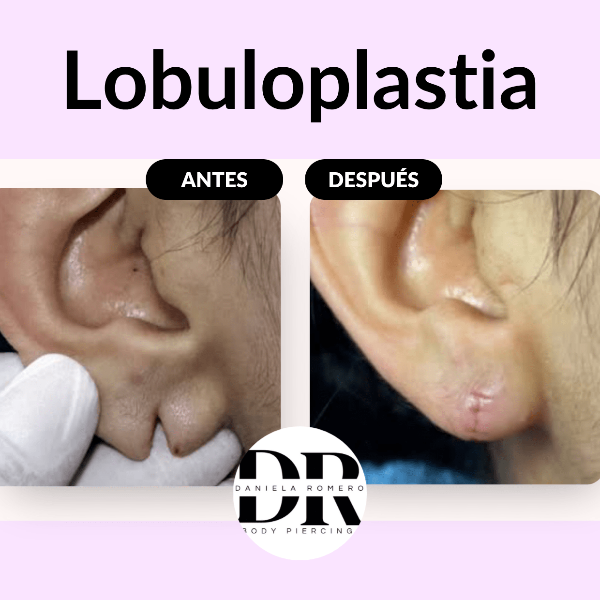 &ldquo;Recupera la forma natural de tus l&oacute;bulos&rdquo;